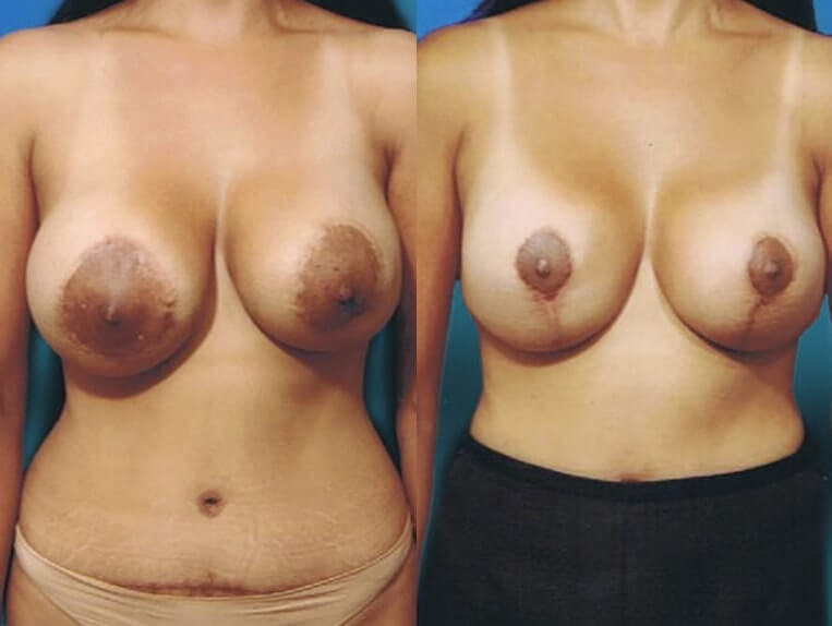 Conversion Benilli to Wise pattern lift, removal of 475cc saline implants and replaced with silicone implants, size 360cc right, 240cc left – 3 months post-op.