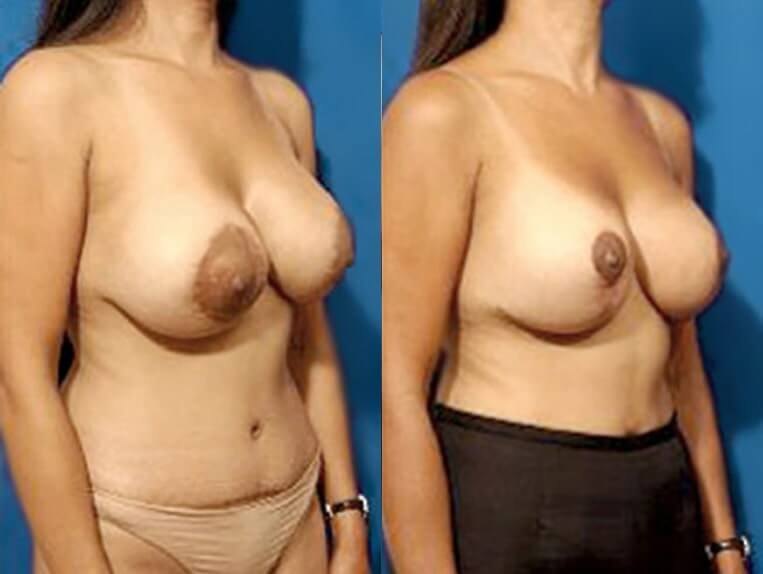 Conversion Benilli to Wise pattern lift, removal of 475cc saline implants and replaced with silicone implants, size 360cc right, 240cc left – 3 months post-op.