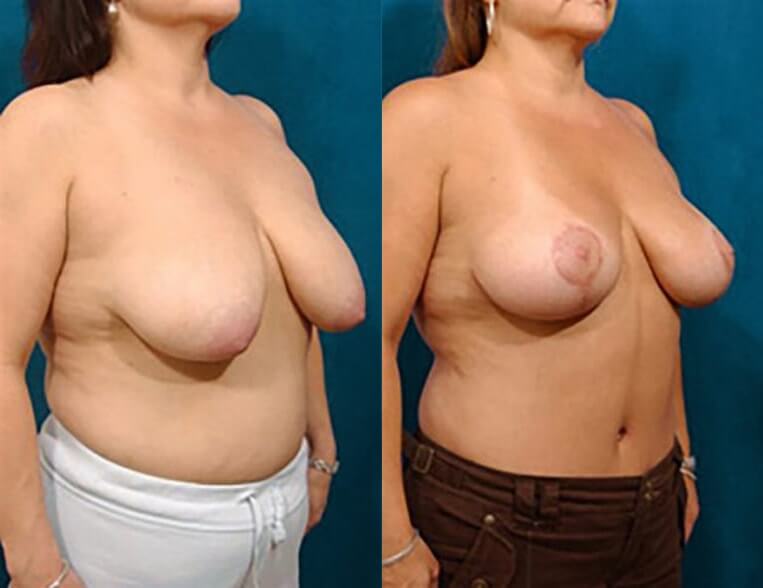 Breast lift – 3 months post-op.