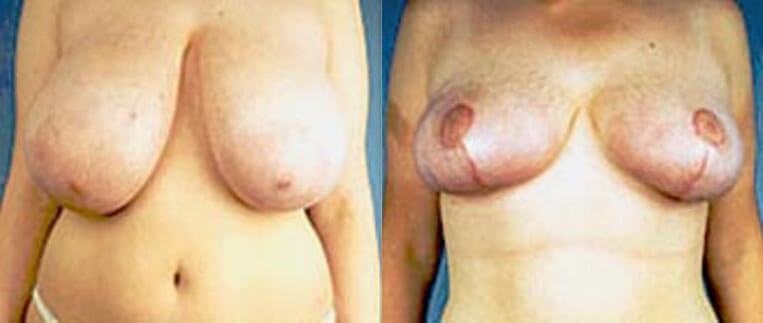 Breast lift