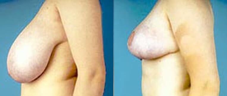 Breast lift