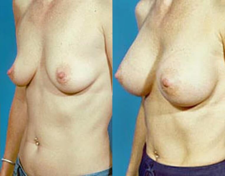 Breast augmentation with smooth saline implants, size 330cc.