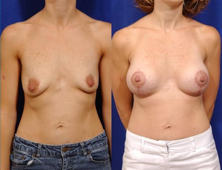Breast Lift with augmentation