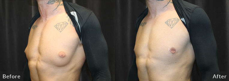 Gynecosmastia with lipo to chest, He was Post op 1 ½ months on his after.
