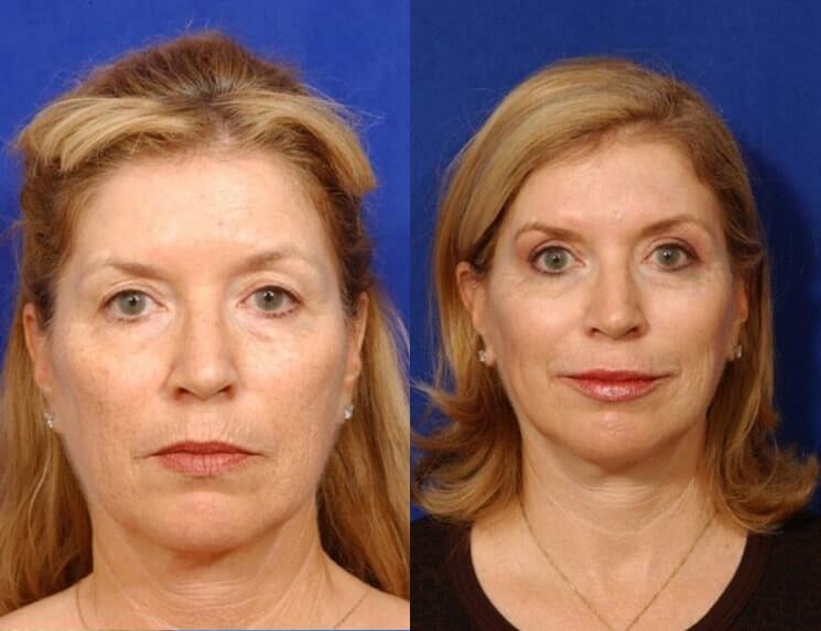 Lip Augmentation