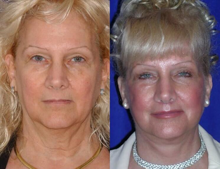 Lip Augmentation