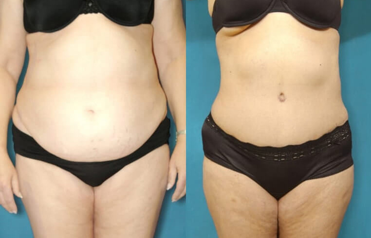 Tummy Tuck with Flank Extension, Liposuction to Abdomen and Flanks
