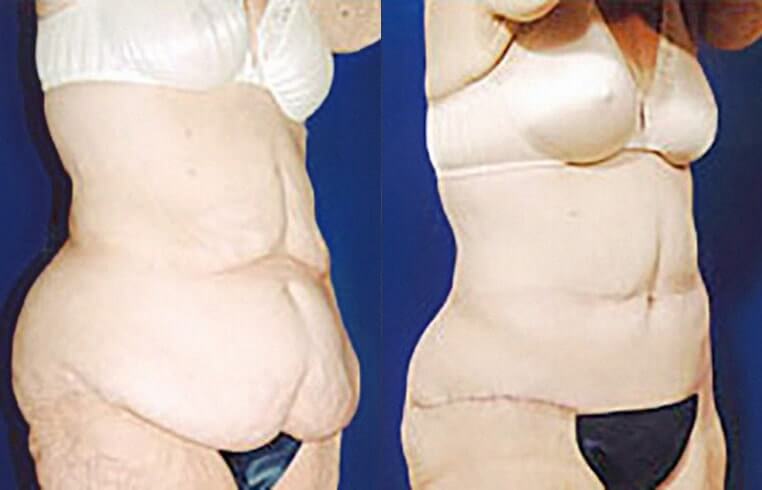 Abdominoplasty and bilateral flank panniculectomy.