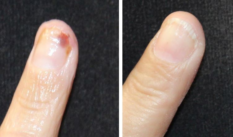 Nail bed repair with microsurgical technique