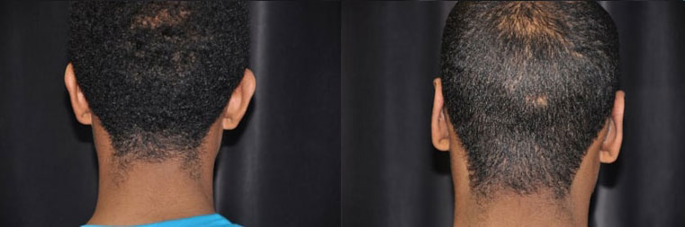 Otoplasty Ear Surgery