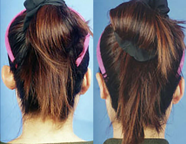 Otoplasty Ear Surgery