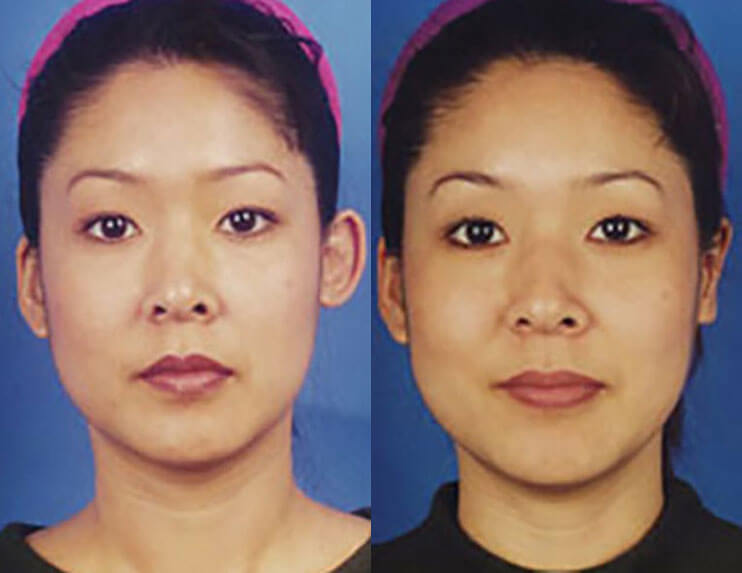 Otoplasty Ear Surgery