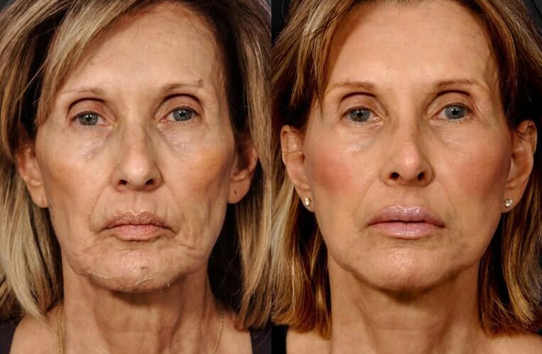 Face and neck-lift with neck-Lace procedure, superficial cheeklift with canthopexy, lower blepharoplasty, Livefill to naso labial folds, marionette, upper-lower lips, brows, DAO muscle release, rhinoplasty with tip plasty, lateral osteotomy, and dorsal reduction.