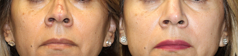 Scar revision and laser for a patient with a dog bite injury to her nose.