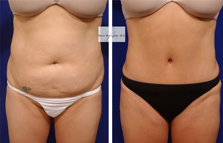 Tummy Tuck with Liposuction to Abdomen and Flanks