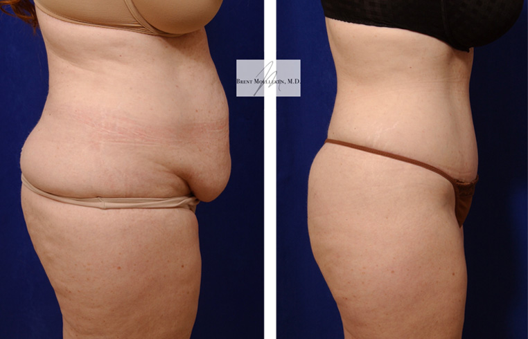 Tummy Tuck with Flank Extension, Diastasis Repair, Liposuction to Abdomen and Flanks