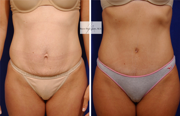Tummy Tuck with Vertical Incision, Diastasis Repair, Liposuction to Abdomen
