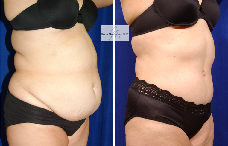 Tummy Tuck with Flank Extension, Liposuction to Abdomen and Flanks