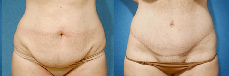 Tummy Tuck with Flank Extension, Diastasis Repair, Liposuction to Abdomen and Flanks