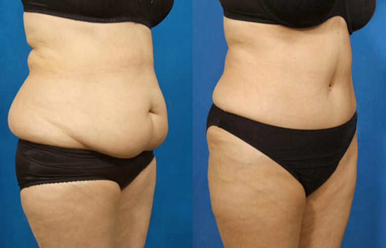 Full abdominoplasty with liposculpture to flanks, abs, and waist.