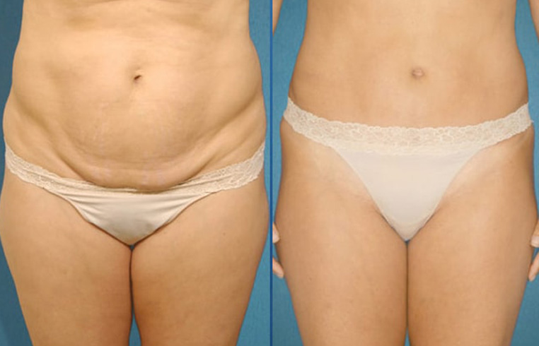 Abdominoplasty tummy tuck with liposculpture of abs and flanks