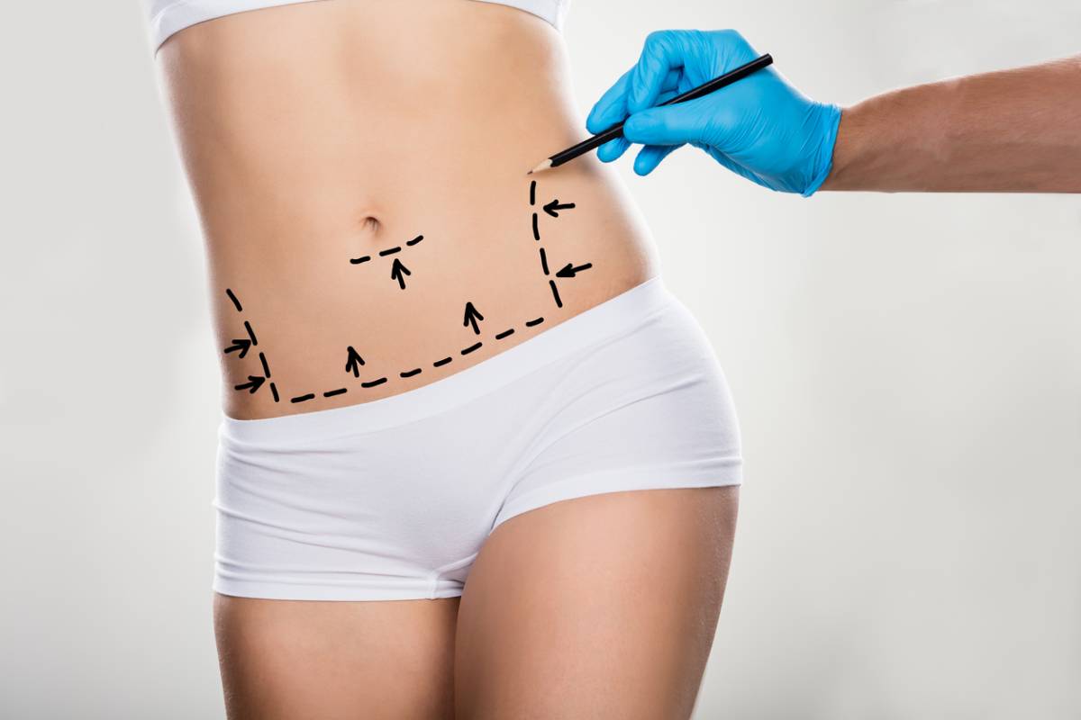 A woman undergoing a surgical procedure on her abdomen, with medical professionals present in a clinical setting.