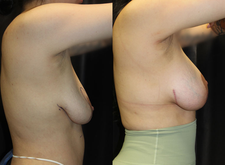 Patient had: removal on implants, placement of new silicone implants 255CC with Mastopexy