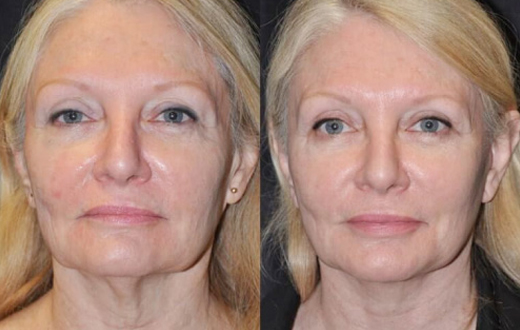 before after facelift procedure patient