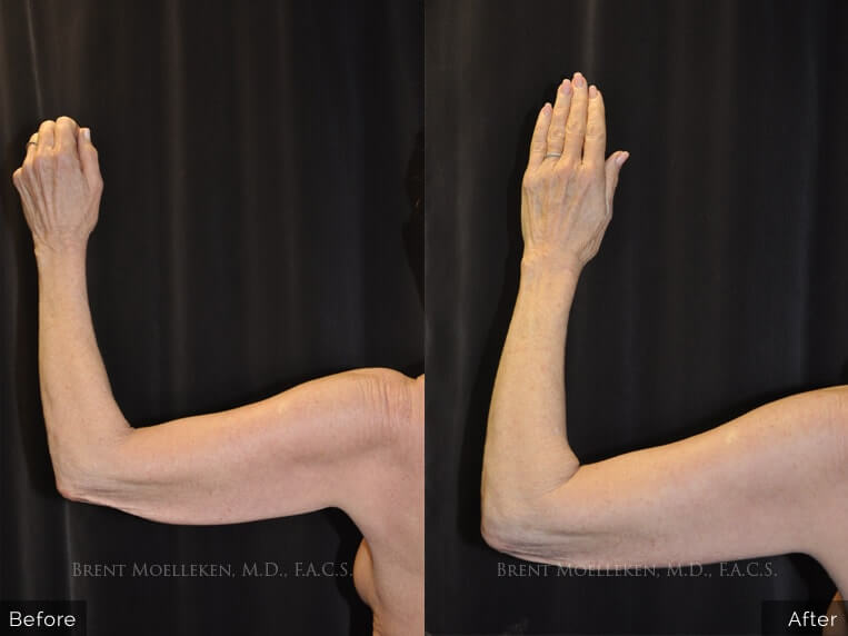 65 yr old Caucasian woman