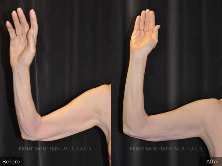 65 yr old Caucasian woman