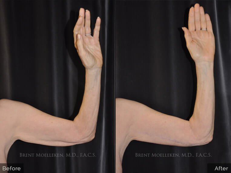 65 yr old Caucasian woman