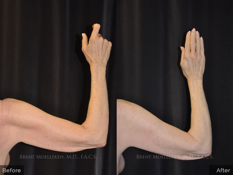65 yr old Caucasian woman