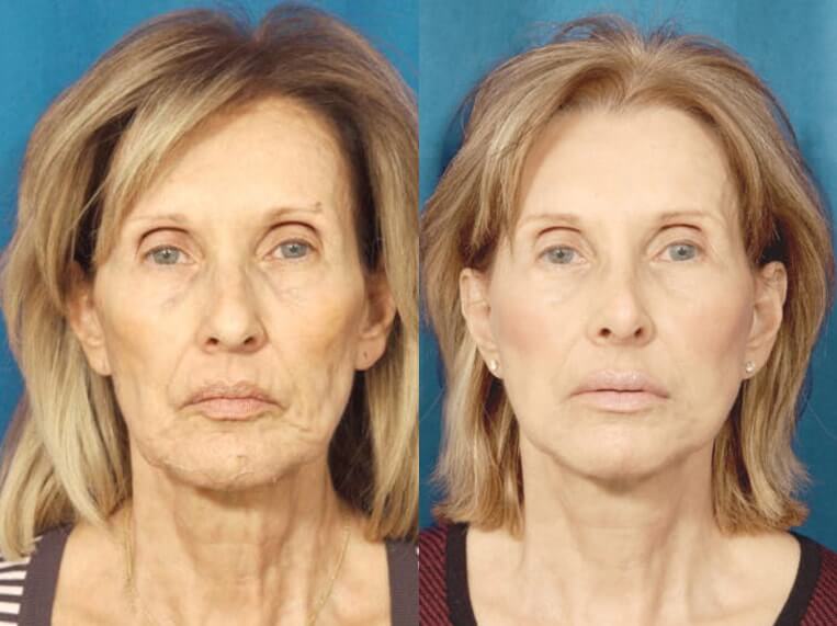 Facelift 360