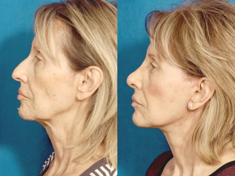 Facelift 360