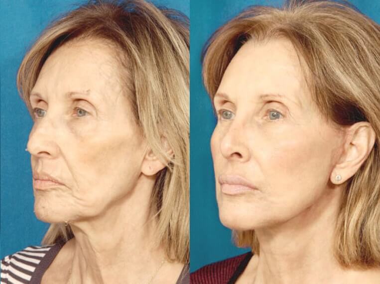 Facelift 360