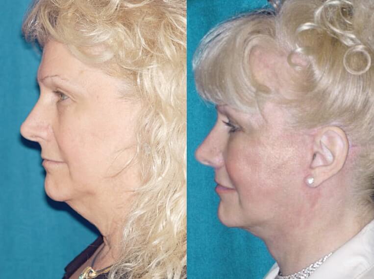 Facelift 360