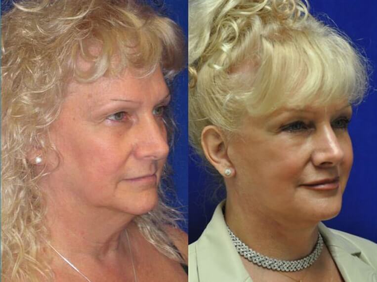 Facelift 360