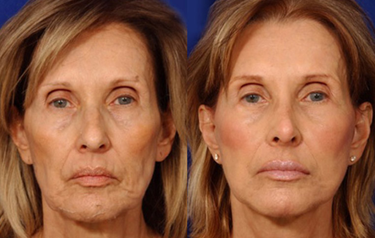 Facelift with Necklace, USIC Cheeklift, Lateral Browlift, Livefill to Naso Labial Folds and Lips, Upper Lip Lift, Rhinoplasty, Co2 Laser