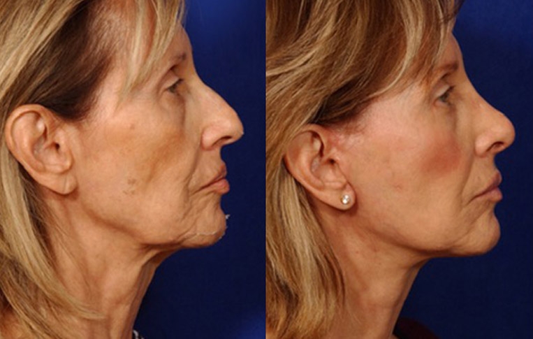 Facelift with Necklace, USIC Cheeklift, Lateral Browlift, Livefill to Naso Labial Folds and Lips, Upper Lip Lift, Rhinoplasty, Co2 Laser