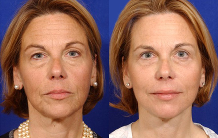 Facelift with Necklace, USIC Cheeklift, Lateral Browlift, Livefill to Naso Labial Folds and Lips, Upper Lip Lift, Rhinoplasty, Co2 to Face and Neck
