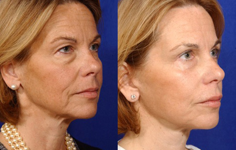 Facelift with Necklace, USIC Cheeklift, Lateral Browlift, Livefill to Naso Labial Folds and Lips, Upper Lip Lift, Rhinoplasty, Co2 to Face and Neck.