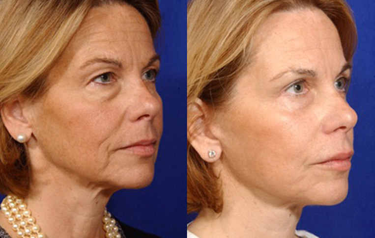 Facelift with Necklace, USIC Cheeklift, Lateral Browlift, Livefill to Naso Labial Folds and Lips, Upper Lip Lift, Rhinoplasty, Co2 to Face and Neck