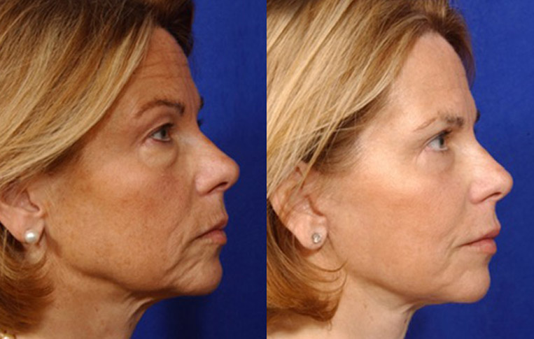 Facelift with Necklace, USIC Cheeklift, Lateral Browlift, Livefill to Naso Labial Folds and Lips, Upper Lip Lift, Rhinoplasty, Co2 to Face and Neck.