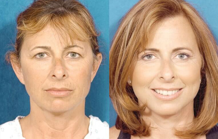 Facelift
