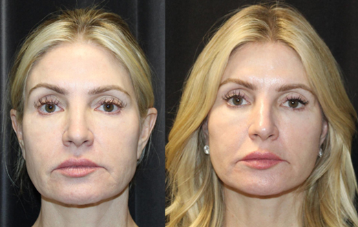 1.Facelift, 2. NeckLace platysmaplasty, 3. Co2 Laser to face, 4.Co2 Laser to neck and chest