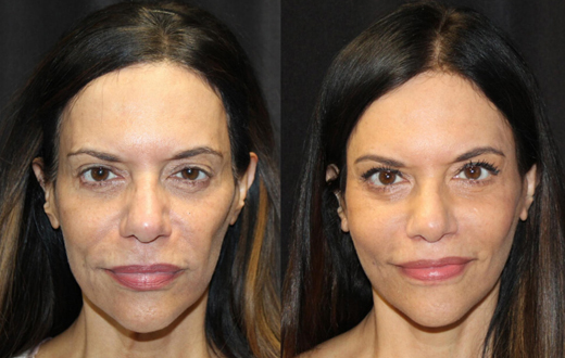 1. Cervicofacial rhytidectomy, High SMAS technique 2. Superficial cheeklift, ultrashort incision type (USIC) 3. Harvest of fat fascial grafts from lower abdomen 4. LiveFill to malar eminences 5. LiveFill to submalar region 6. LiveFill to temporal hollowing 7. Lateral brow lift, nerve sparing 8. Reverse brow lift with galeal scoring