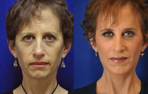 Facelift