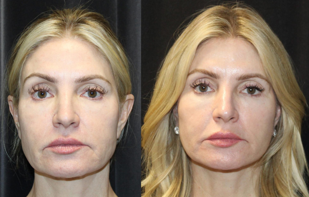1.Facelift, 2. NeckLace platysmaplasty, 3. Co2 Laser to face, 4.Co2 Laser to neck and chest