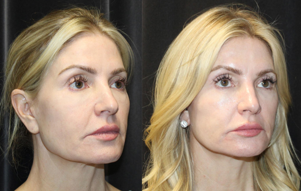 1.Facelift, 2. NeckLace platysmaplasty, 3. Co2 Laser to face, 4.Co2 Laser to neck and chest
