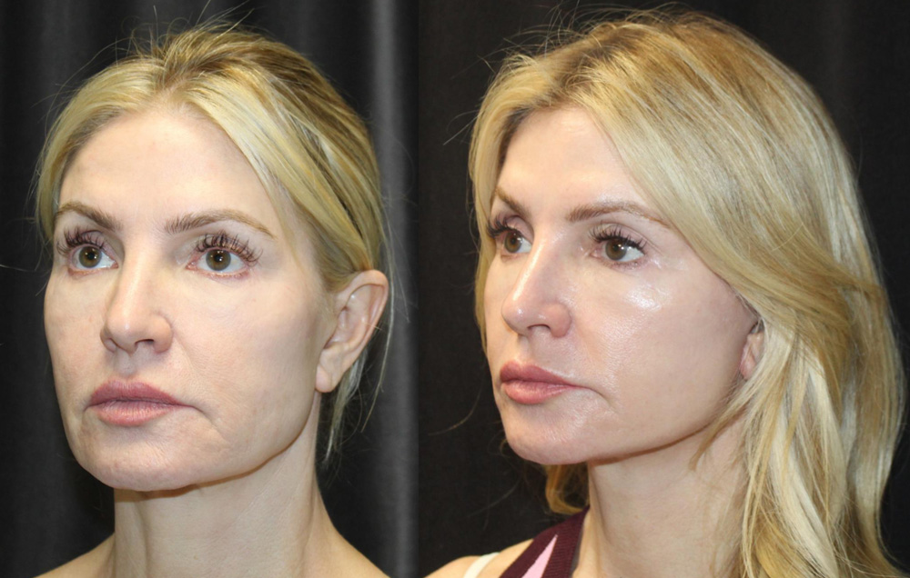 1.Facelift, 2. NeckLace platysmaplasty, 3. Co2 Laser to face, 4.Co2 Laser to neck and chest
